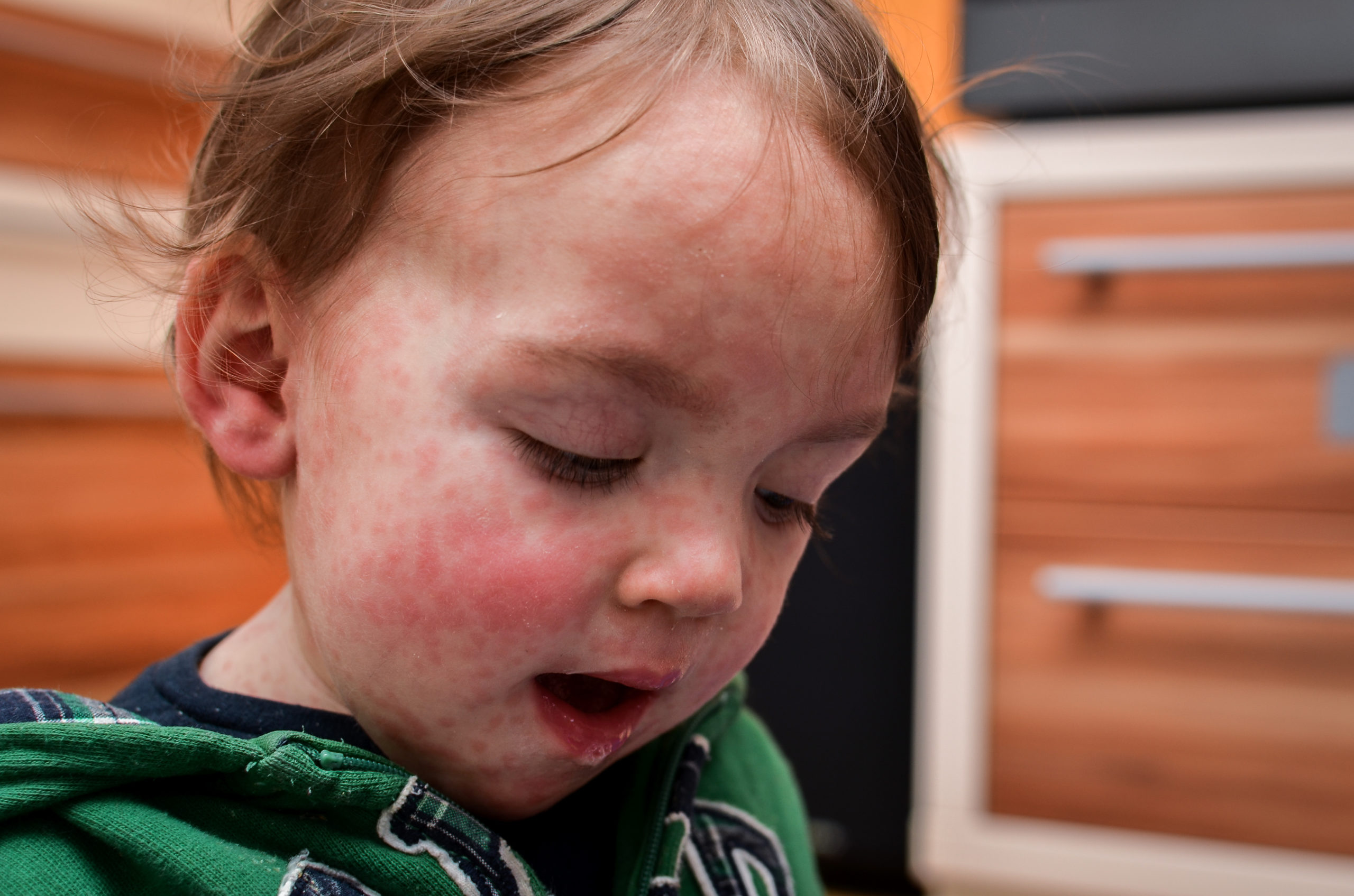 Children viral disease or allergies. Red measles rash on baby.