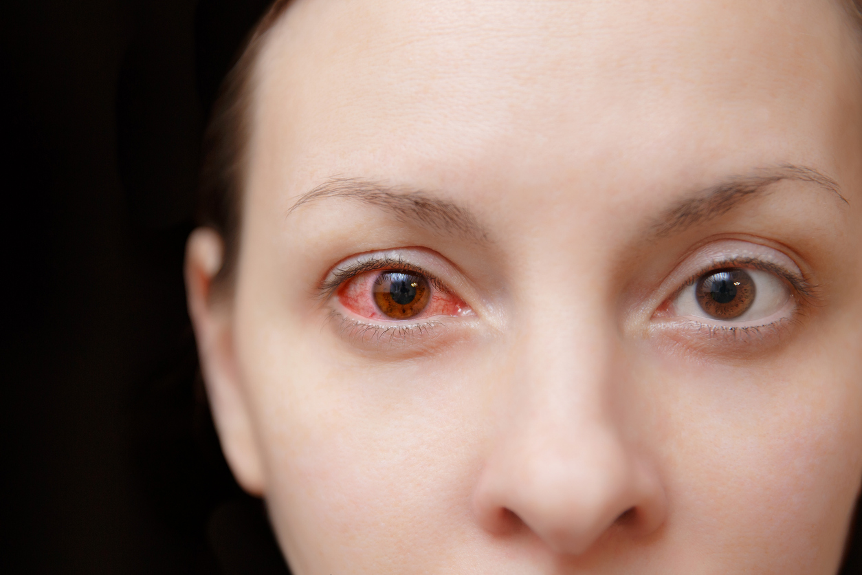 Close-up of a woman's red, bloodshot eye from allergic conjunctivitis irritation